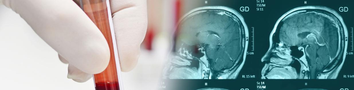 Alzheimer's detection via blood test